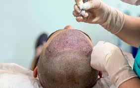 Transform Your Look with Hair Transplant in Dubai: A Comprehensive Guide